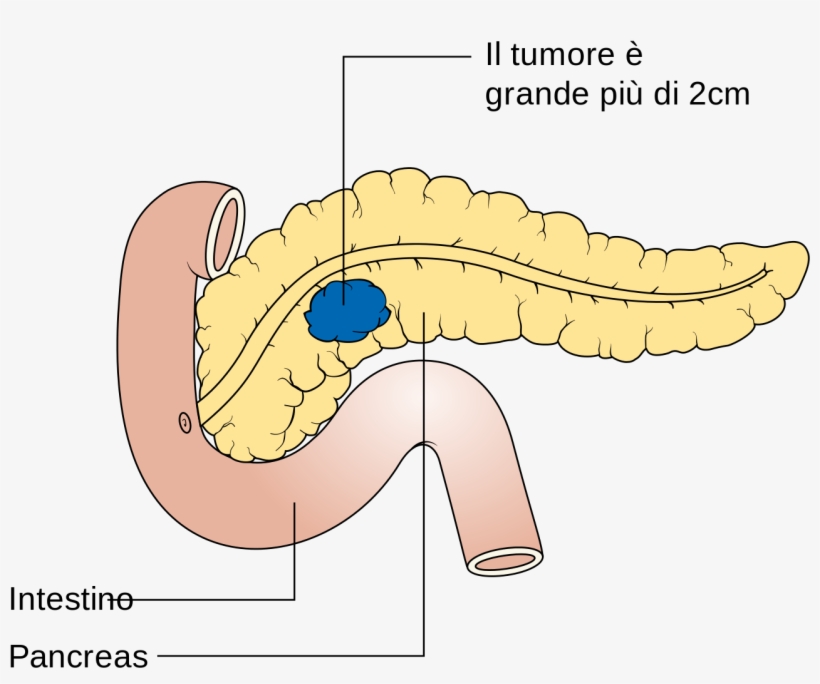 Diagram Showing Stage T2 Cancer Of The Pancreas Cruk - Tumore Wikipedia, transparent png download