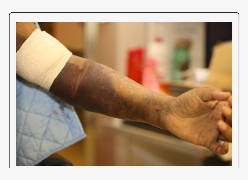 Hematoma Of Left Anterior Cubital Fossa, After Blood - Cubital Fossa, transparent png download