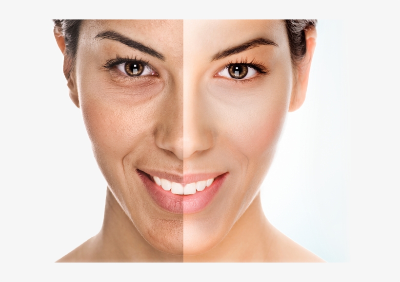 Dermapen Vs Laser Co2, transparent png download