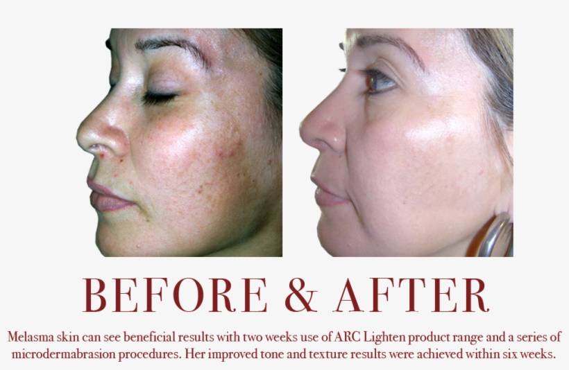 Lightening Melasma Mottled Skin Tone Discolorations - Poster, transparent png download