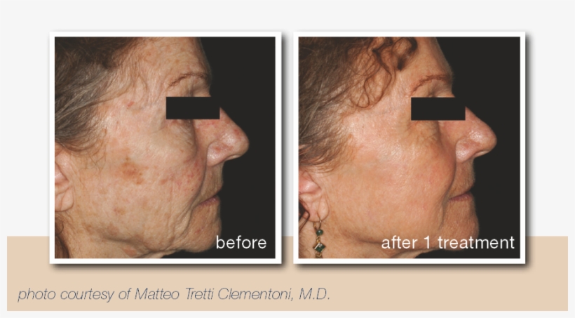 Before And After Pictures For Patients With Deep Wrinkles - Patient, transparent png download