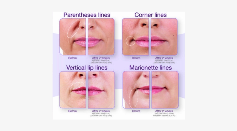 You Can Expect A Little Redness And Swelling Over The - Best Filler For Lip Lines, transparent png download