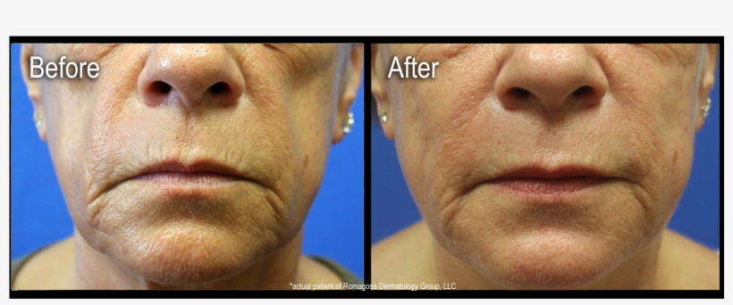 Are Injectable Gels Used To Restore Fullness And Volume - Animal, transparent png download