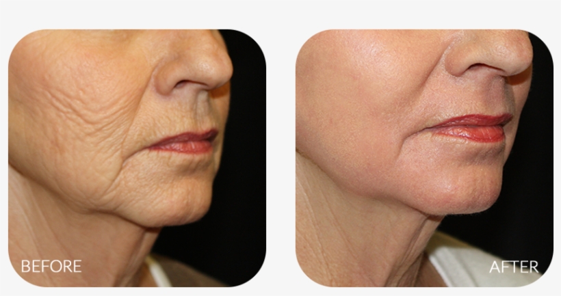Wrinkles, Creases, And Sags Are Inevitable As We Age - Chemical Peel, transparent png download