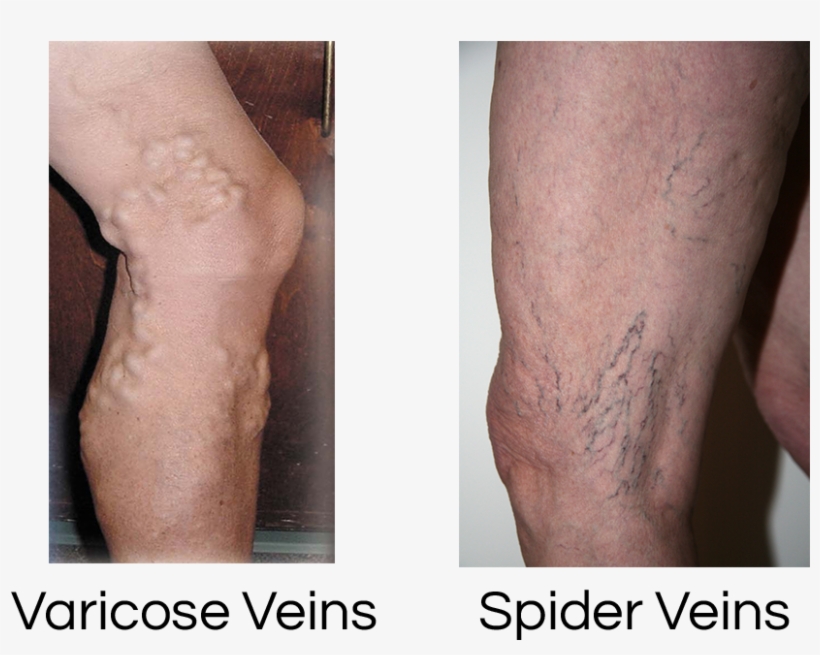 Vein Disorders - Spider Veins, transparent png download