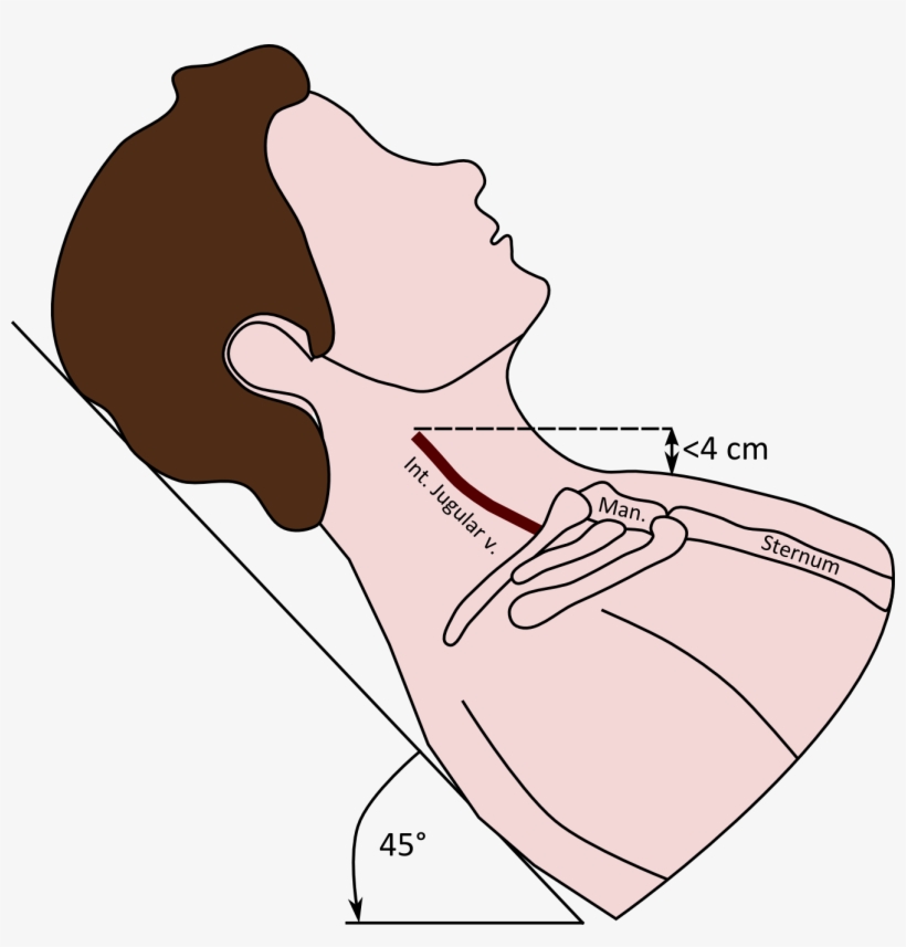 Flat Jugular Veins Photos - Jvp Angle Of Louis, transparent png download