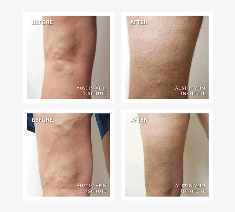 Case - Before And After Long Distance Running, transparent png download