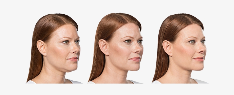 Weight Before Treatment - Chin Weight Loss Before And After Side Profile, transparent png download