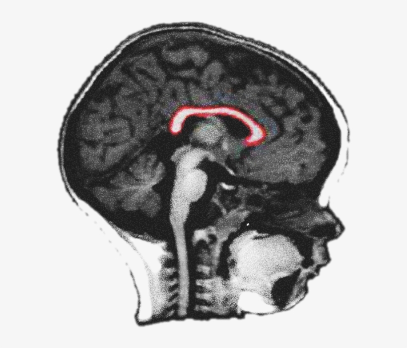 1 - Corpus Callosum Baby Mri, transparent png download