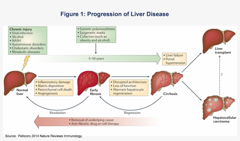 A Number Of Companies Are Currently Developing Treatments - Liver Fibrosis Cirrhosis, transparent png download