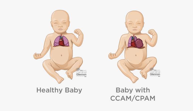 How Are Lung Masses Diagnosed And Managed During Pregnancy - Congenital Cystic Adenomatoid Malformation Ccam, transparent png download
