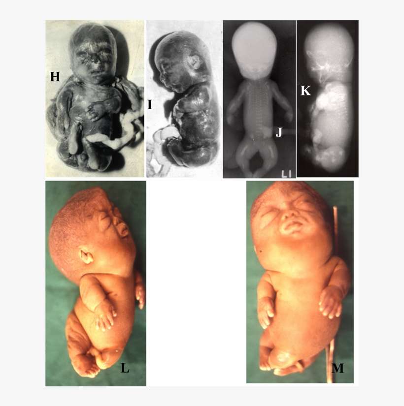 (r) Showing Lethal Skeletal Dysplasia - Platyspondylic Lethal Skeletal Dysplasia, Torrance, transparent png download