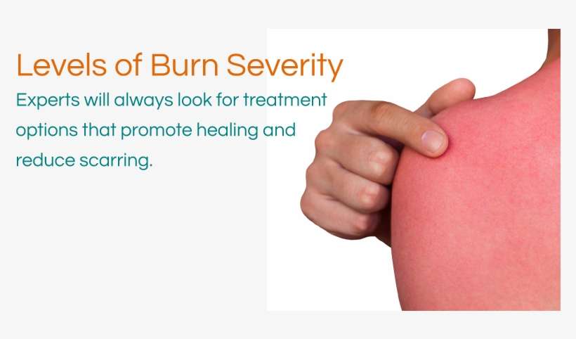 Levels Of Burn Severity - Sunburned Skin, transparent png download