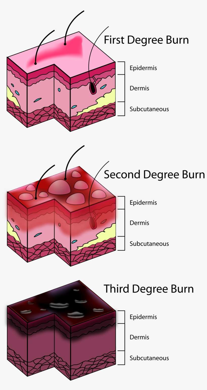 Three Degrees Of Burns - Degrees Of Burn, transparent png download