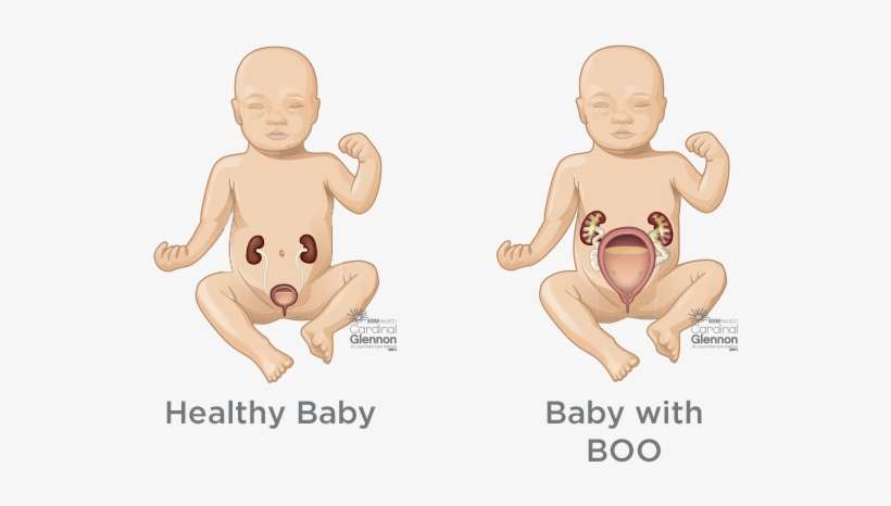 Bladder Outlet Obstruction - Baby Kidney, transparent png download