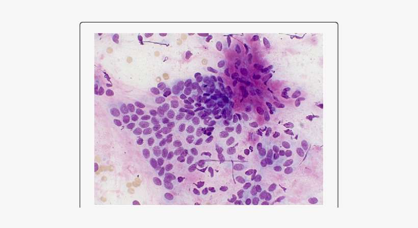 Components Of A Mixed Mammary Tumor In A Female Canine - Mammary Carcinoma Dog Cytology, transparent png download
