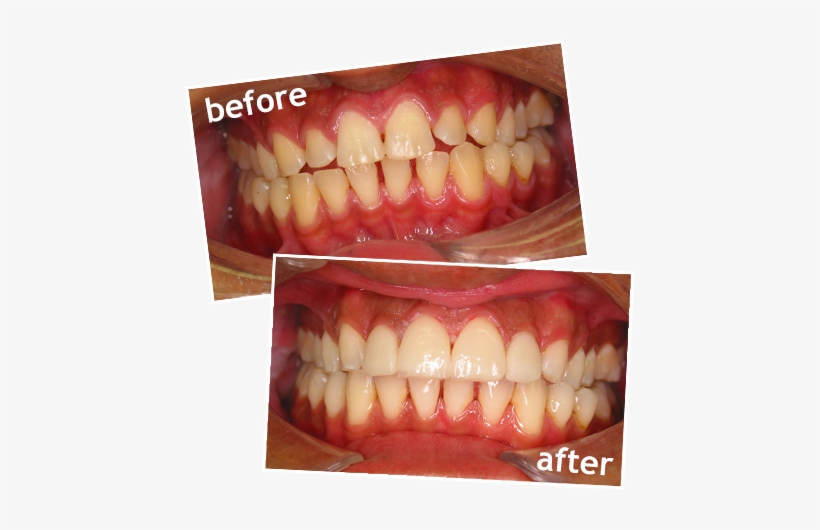 Glamsmile Porcelain Veneers Before After Sidebar - Veneer, transparent png download