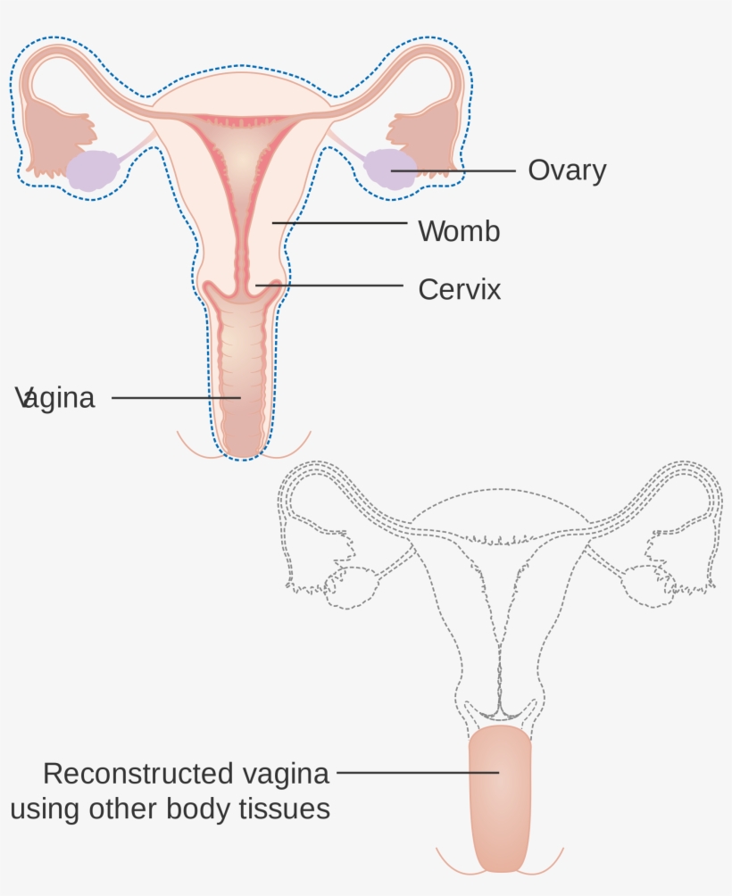 Diagram Showing A Radical Hysterectomy With A Reconstructed - Radical Hysterectomy Diagram, transparent png download