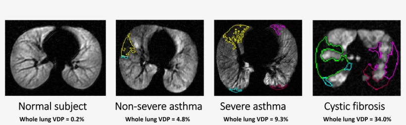 Examples Of Detected Ventilation Defect Boundaries - Magnetic Resonance Imaging, transparent png download