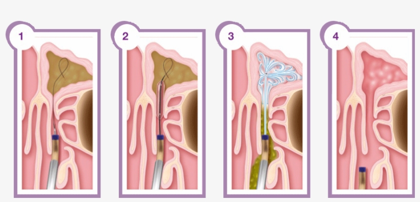 Balloon Sinuplasty Is A New Minimally Invasive Sinus - Functional Endoscopic Sinus Surgery Steps, transparent png download