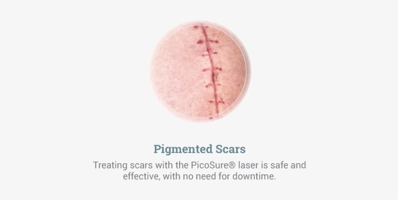 Pigmented-scars - Pigment, transparent png download
