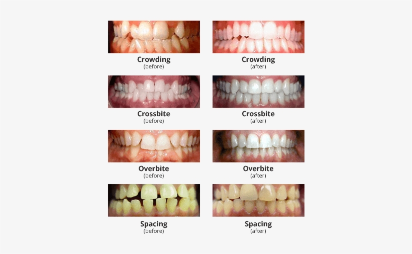 Improve Your Smile, Your Confidence & Your Life - Does Invisalign Work, transparent png download