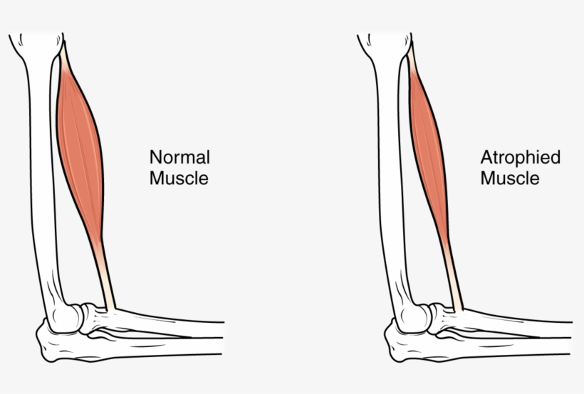 Learn How The Freedom Bed™ Helps Reduce Complications - Muscle Atrophy, transparent png download