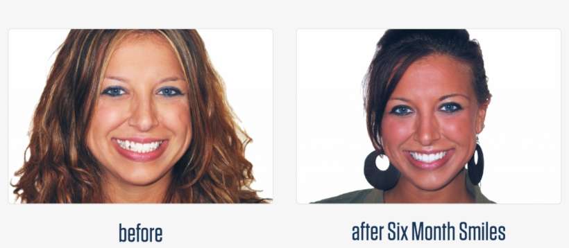 Six Month Smiles - Northside Family Dentistry, transparent png download