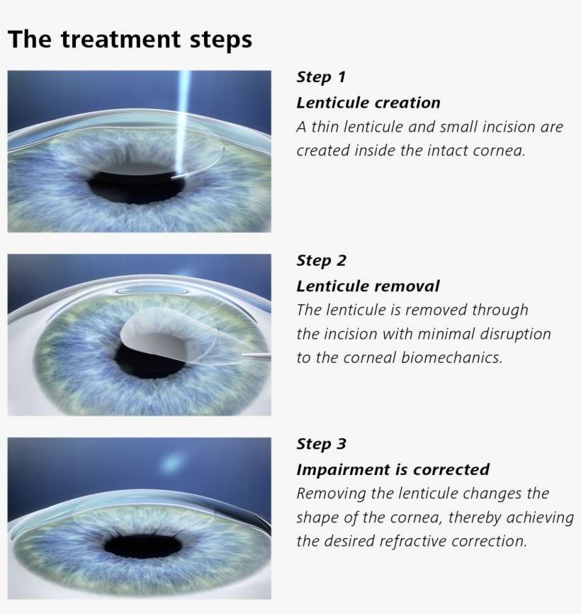 Description Of Treatment Steps With Smile - Zeiss Smile, transparent png download