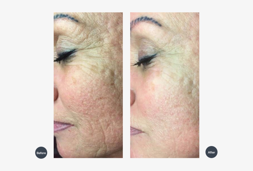 Treatment Of Skin Texture And Rejuvenation - Scar, transparent png download