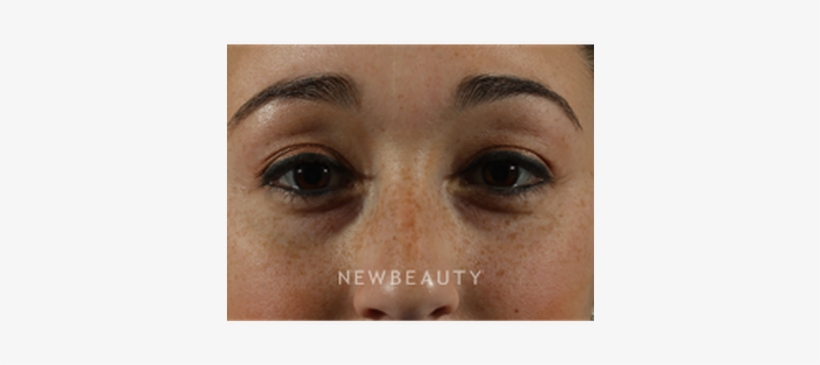 Dr Marina Peredo Restylane B - Close-up, transparent png download