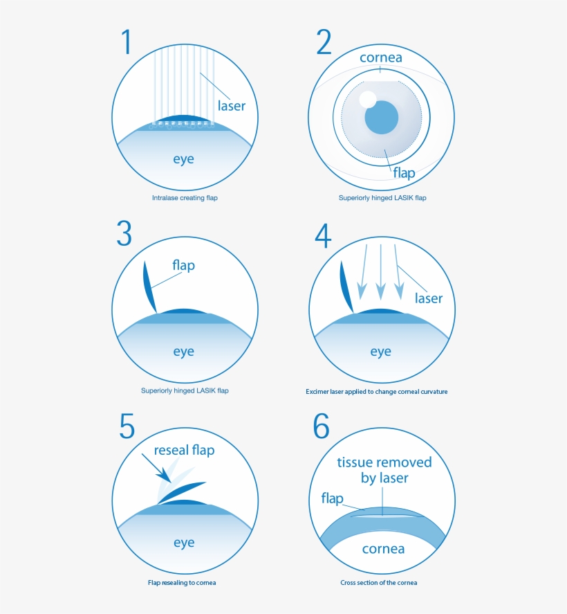 Are You Suitable For Laser Eye Surgery - Lasik Eye Surgery Steps, transparent png download