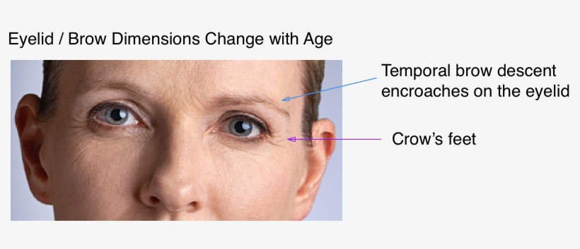 Brow Lift - Forehead Lift, transparent png download