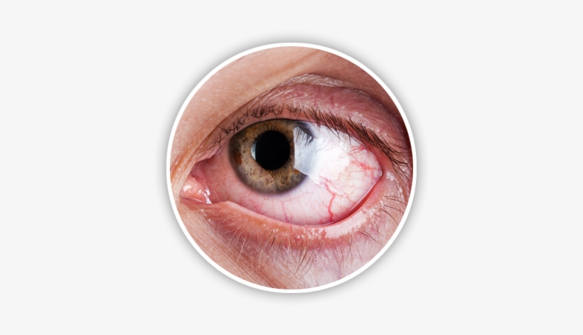 Dry Eyes San Antonio - Mild Uveitis, transparent png download