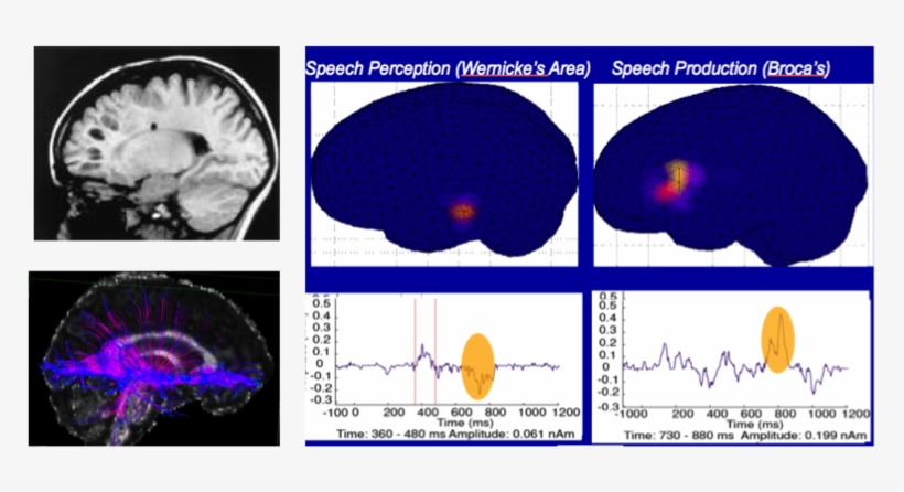New Neuroimaging Techniques Are Beginning To Outline - Bilingual Brain Structure, transparent png download