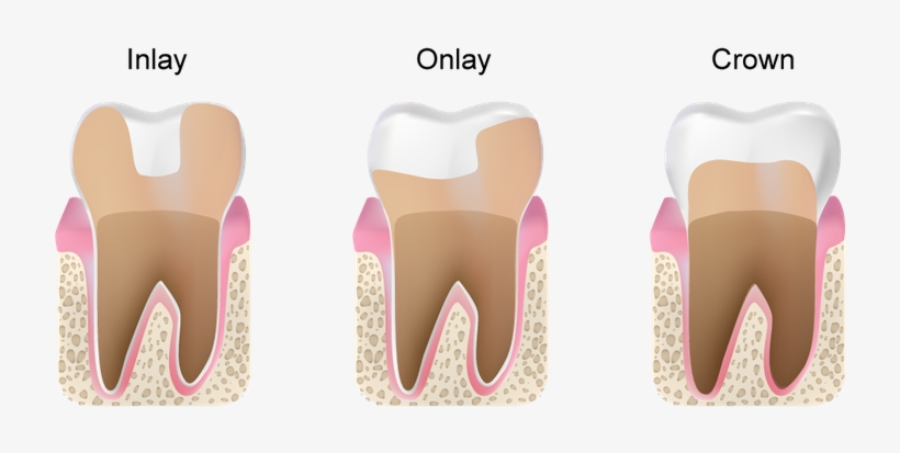 Porcelain Crowns Inlay Onlay - Inlays And Onlays, transparent png download