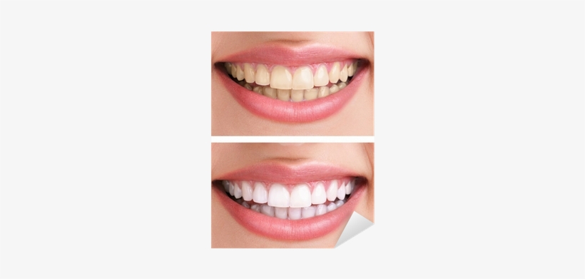 Use Whitening Gel Without Tray, transparent png download