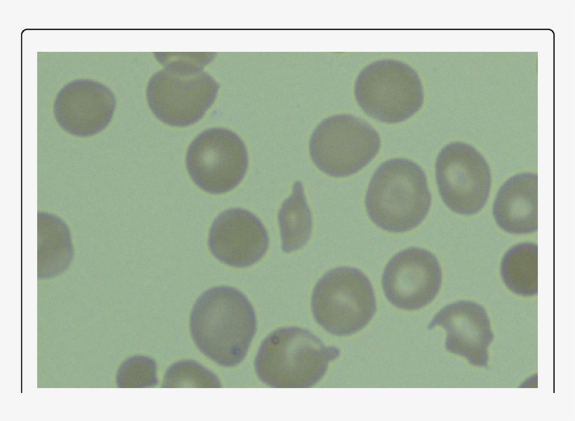 Peripheral Blood Smear With Schitocytosis - Circle, transparent png download