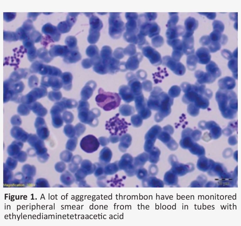 In The Patient For Whom Pseudothrombocytopenia Is Considered, - Poster, transparent png download
