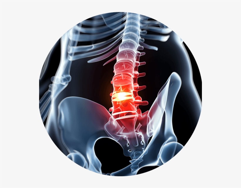 When The Spine Begins To Narrow Putting Pressure On - Catastrophic Injury Definition, transparent png download