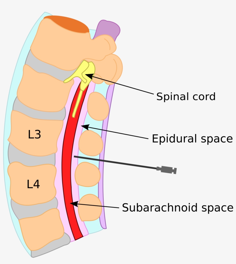 By Allison Wallis - Csf And Epidural Space, transparent png download