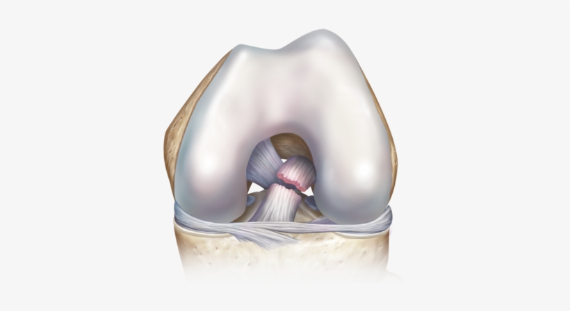 Acl Tear 0 Large - Torn Acl Png, transparent png download