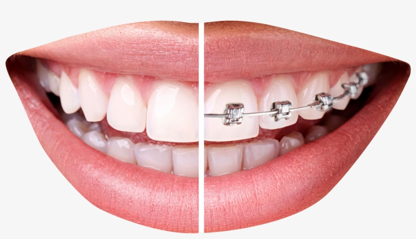 2135 X 1656 - Braces Png, transparent png download