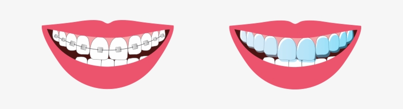 Braces Are Dental Devices Used To Straighten Crooked - Clear Aligners, transparent png download