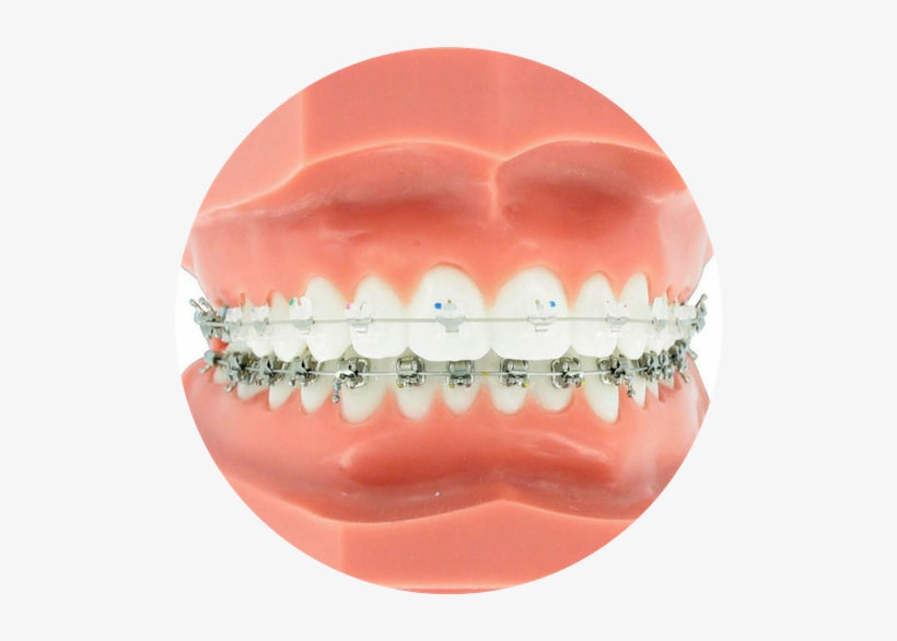Clear Braces, transparent png download