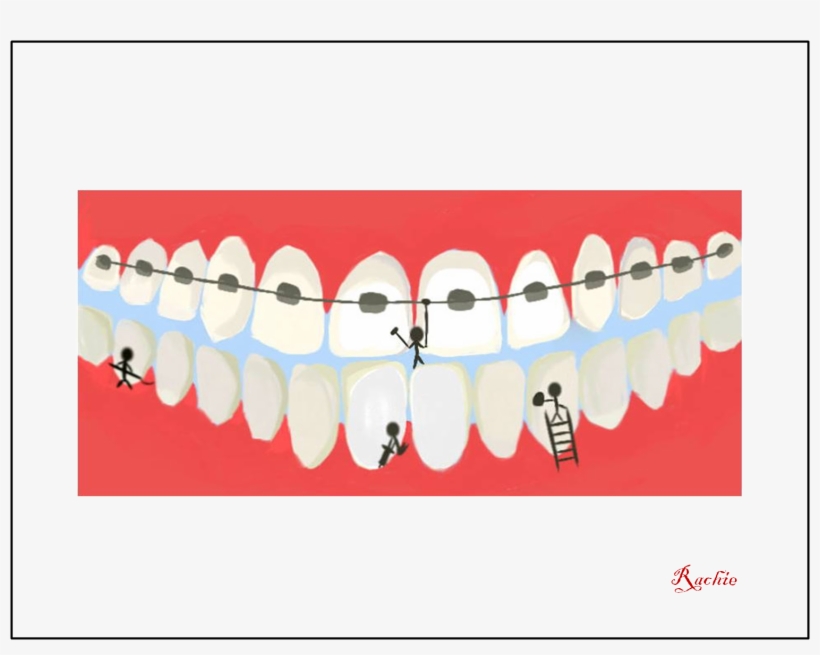 Braces Cleaning - Diagram, transparent png download