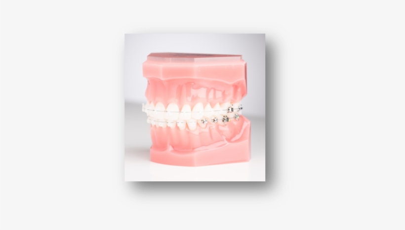 Self Ligating Ceramic Braces - Plastic, transparent png download