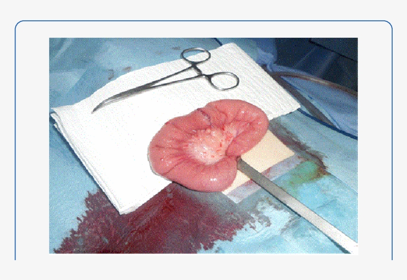 Operative View After Partial Small Bowel Resection - Still Life, transparent png download