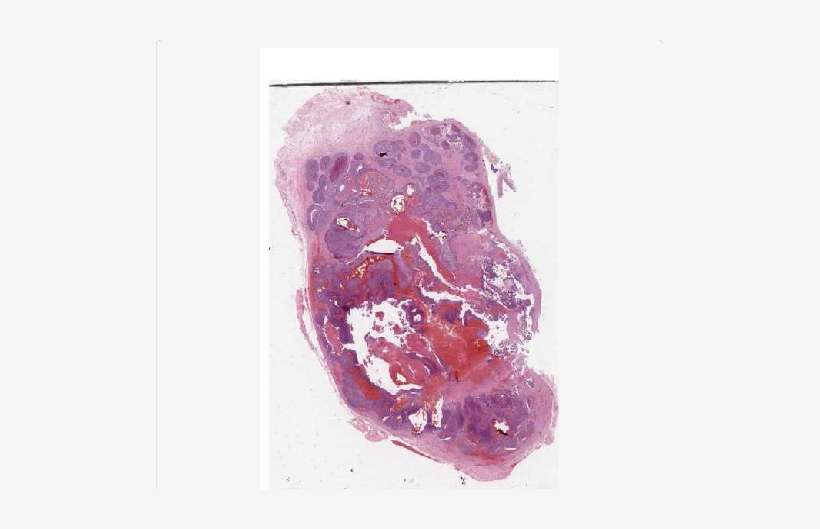 The Neoplastic Nodule Was Partially Cystic With Irregular - Medicine, transparent png download