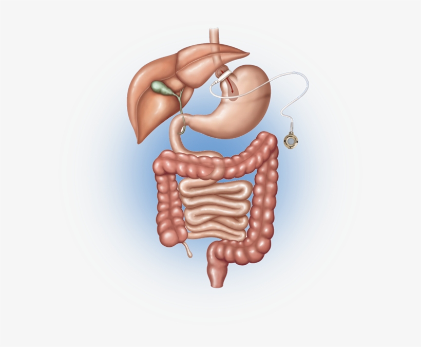 Your Ultimate Goal Of Weight Loss Surgery Is To Live - Vertical Sleeve Gastrectomy, transparent png download